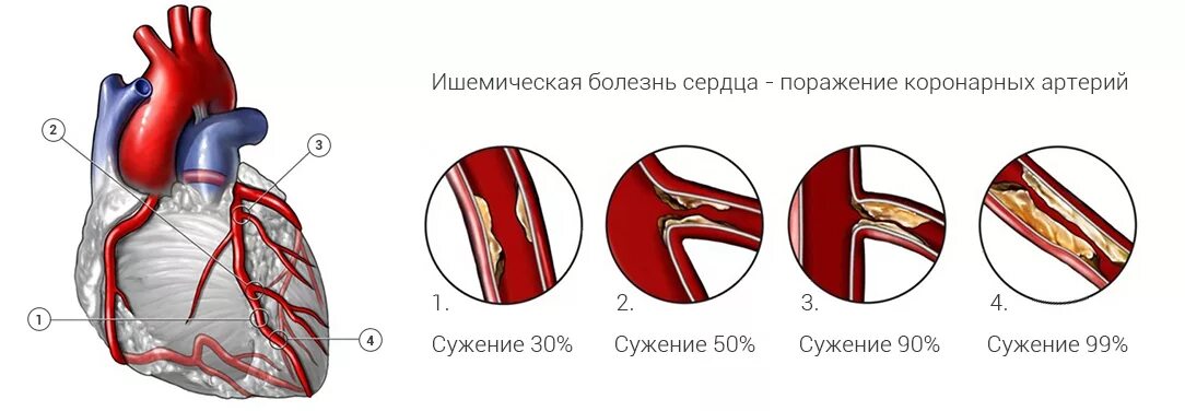 Сужение сосудов причины лечение. Ишемическая болезнь сердца (ИБС). Степени сужения коронарных артерий. Изменения в коронарных артериях при ишемической болезни сердца.. Ишемическая болезнь сердца атеросклероз коронарных артерий.