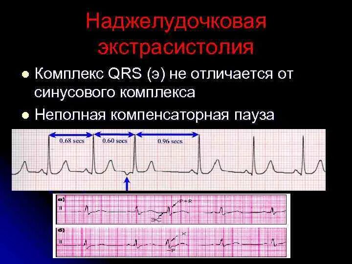 Одиночная наджелудочковая экстрасистолия на экг. Единичные суправентрикулярные экстрасистолы. Супкрвентикцлярна экстрасистолия. Наджелудочковая экстрасистолия на экг. Экг с наджелудочковой экстрасистолией.