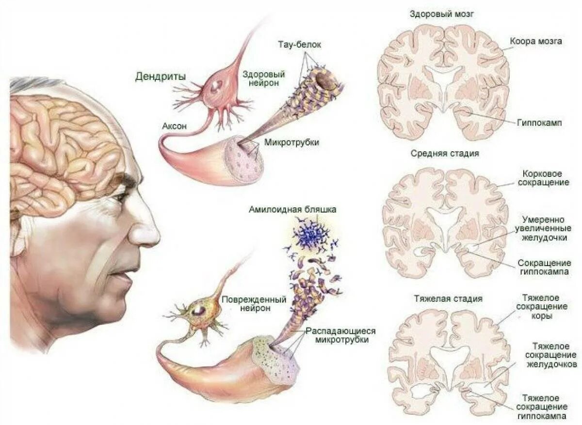 Деменция головы. Этиопатогенез болезни Альцгеймера. Механизм развития Альцгеймера. Болезнь Альцгеймера патогенез. Болезнь Альцгеймера локализация поражения.