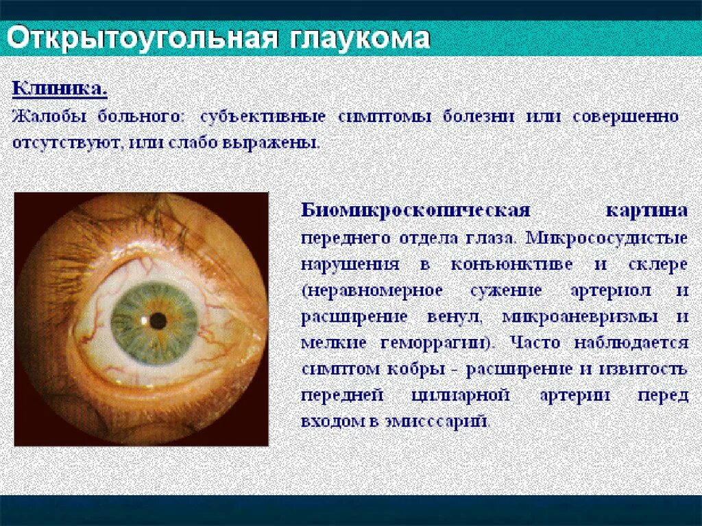 Первичная открытоугольная глаукома. Симптомы открытоугольной глаукомы. Закрытоугольная глаукома патанатомия. Причины первичной глаукомы.