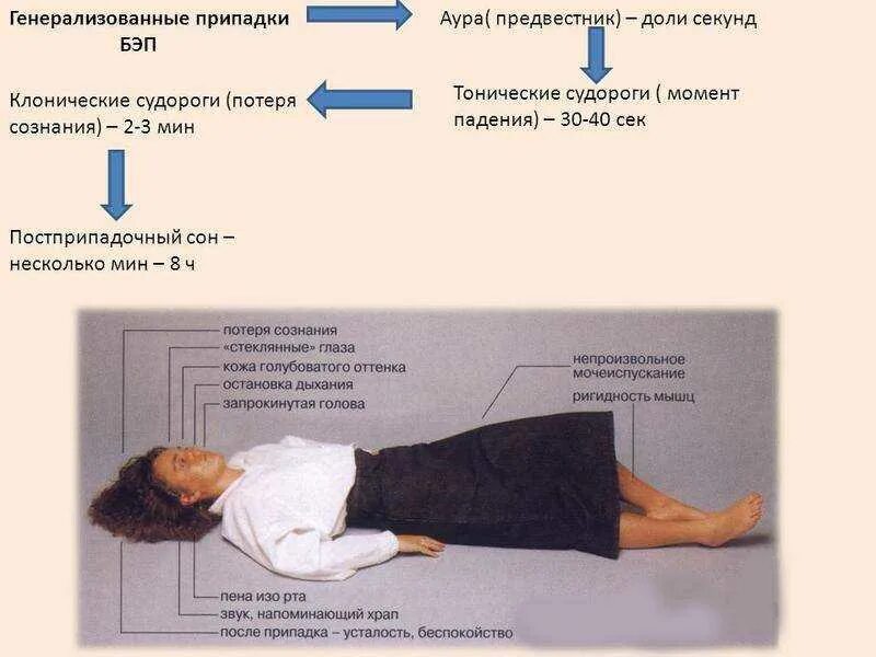 Эпилепсия у взрослого мужчины симптомы. Генерализованный судорожный припадок. Генерализованные припадки эпилепсии. Клонические приступы эпилепсии.