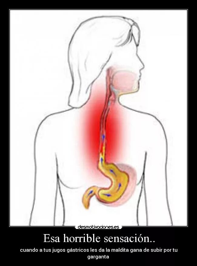 Боль в пищеводе отдает. Химический ожог пищевода.