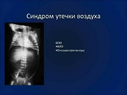 Признаки утечки воздуха