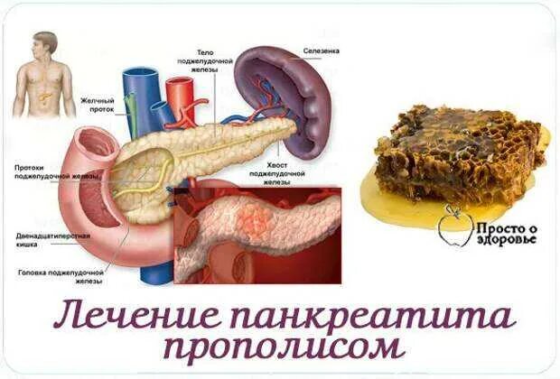 Поджелудочная как лечить