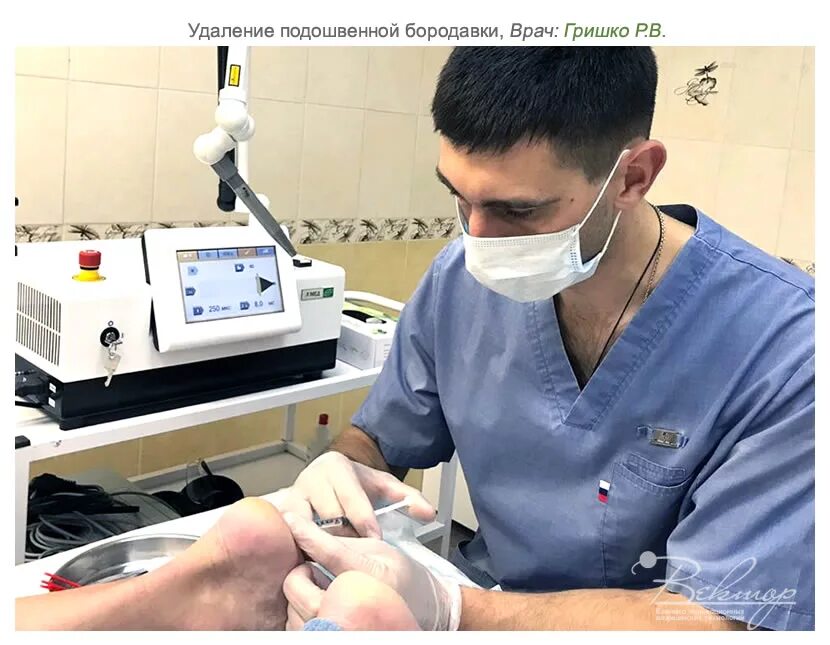 Удаление бородавок лазером ребенку