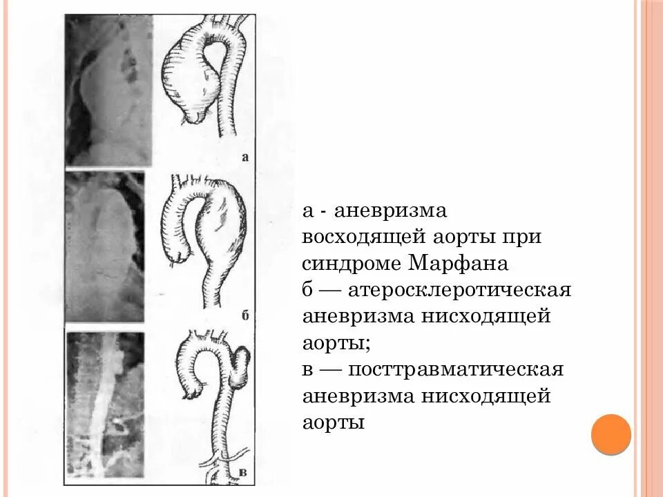 Аневризматическое расширение восходящего отдела грудной аорты. Аневризма восходящего отдела грудной аорты. Фузиформная аневризма восходящего отдела грудной аорты. Аневризма нисходящего отдела аорты на рентгене. Аневризма восходящей аорты операция