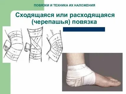 Повязка сходящаяся на коленный