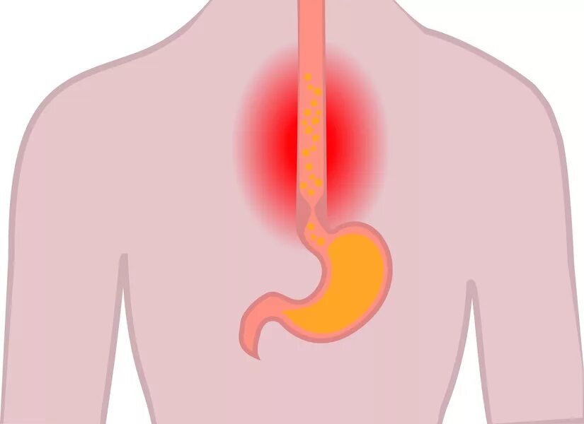 Стадии химического ожога пищевода. Ожоги пищевода клинические рекомендации. Химический ожог пищевода классификация. Ожоги пищевода клинические рекомендации. Классификация ожогов пищевода.