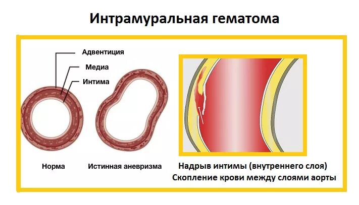 Диссекция артерии на узи. Гематома аорты. Гематома аорты. Интрамуральная гематома сонной артерии. Пенетрирующая язва аорты узи.