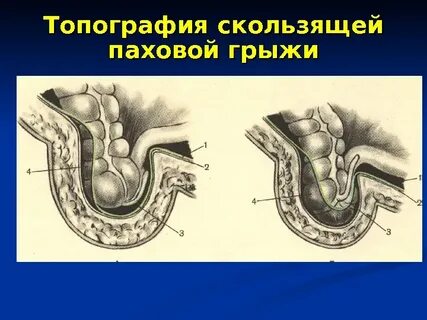 Лечение паховой грыжи отзывы