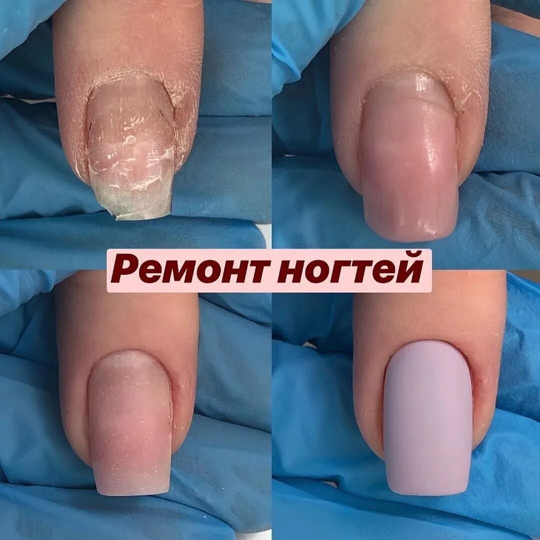 Отслаивается полигель