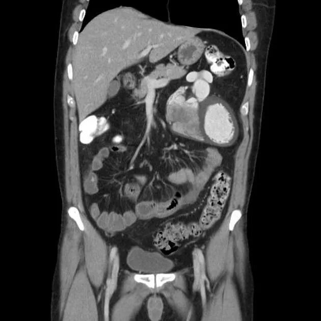 Лимфангиома брыжейки кт. Неспецифический язвенный колит на кт. Лимфангиома брюшной полости кт. Кт органов брюшной полости грудной клетки