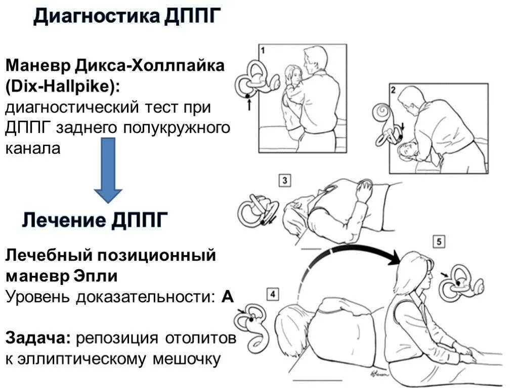 Гимнастика при головокружении ДППГ. Вестибулярная гимнастика маневр Эпли. Маневры при головокружении ДППГ. ДППГ заднего полукружного канала маневры.