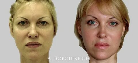 Перелом средней зоны лица
