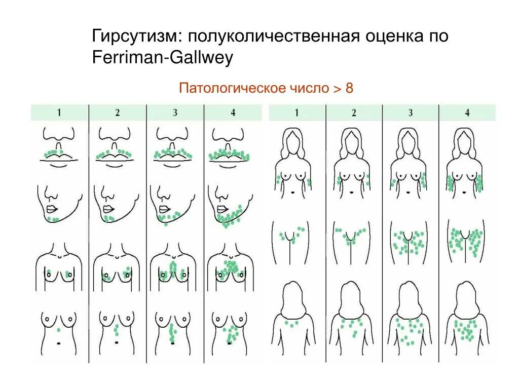 До скольки растет мужской половой. Ферримана Голлвея. Шкала гирсутизма Ферримана Голлвея таблица. Шкала оценки гирсутизма. Модифицированная шкала Ферримана-Голлвея.