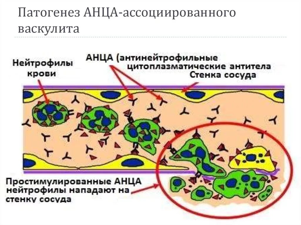 АНЦА-ассоциированные васкулиты патогенез. АНЦА васкулит патогенез. Системные васкулиты патогенез схема. АНЦА патогенез. Васкулит патогенез