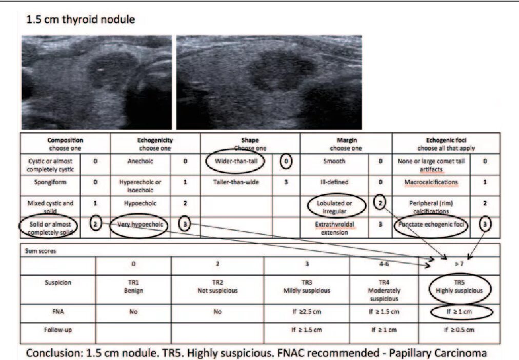 Ti-rads 1 щитовидной железы. Щитовидная железа классификация ti-rads. Классификация ti rads при УЗИ щитовидной. Tirads 1 щитовидной железы что это. Ti rads узи