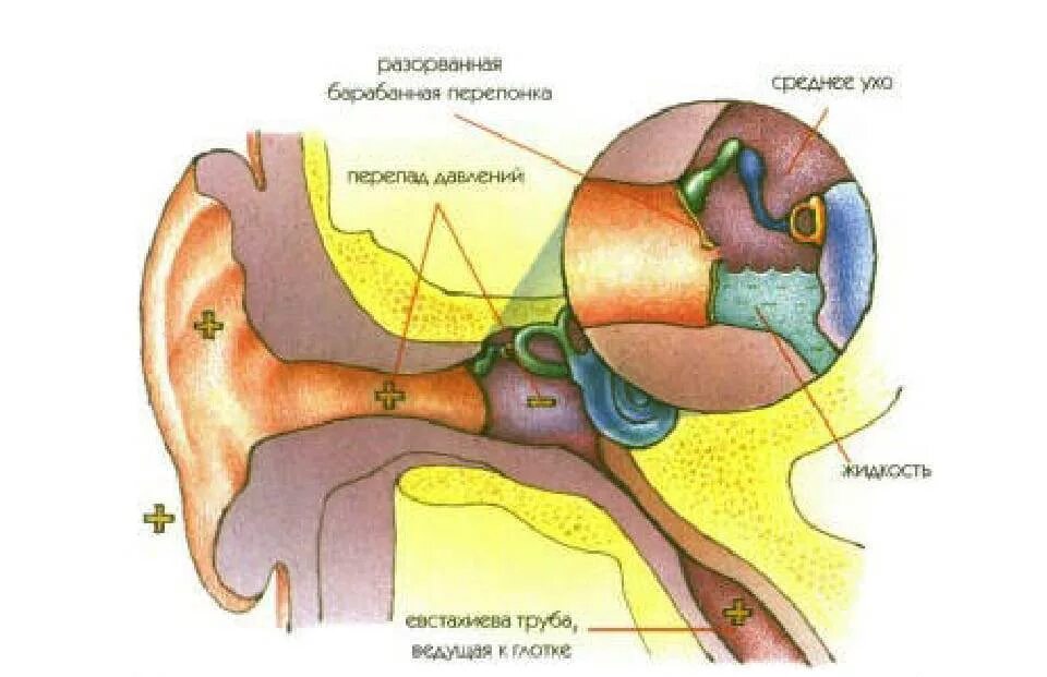 Какое давление в среднем ухе. Барабанной перепонки аэроотит. Баротравма среднего уха. Баротравма барабанной перепонки.