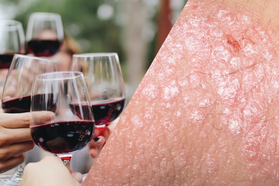 Кожные реакции на алкоголь. Реакция на красное вино. Аллергия после алкоголя. Аллергия на алкоголь проявление. Может ли быть аллергия на вино.