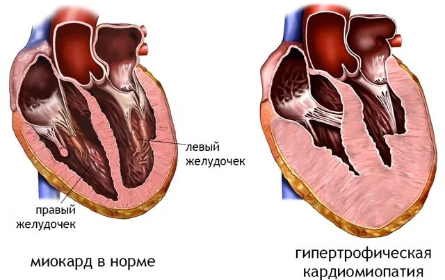 Гипертрофия миокарда норма. Гипертрофия миокарда левого желудочка. Гипертрофированный миокард левого желудочка. Масса миокарда левого желудочка гипертрофия. Миокард правого желудочка сердца