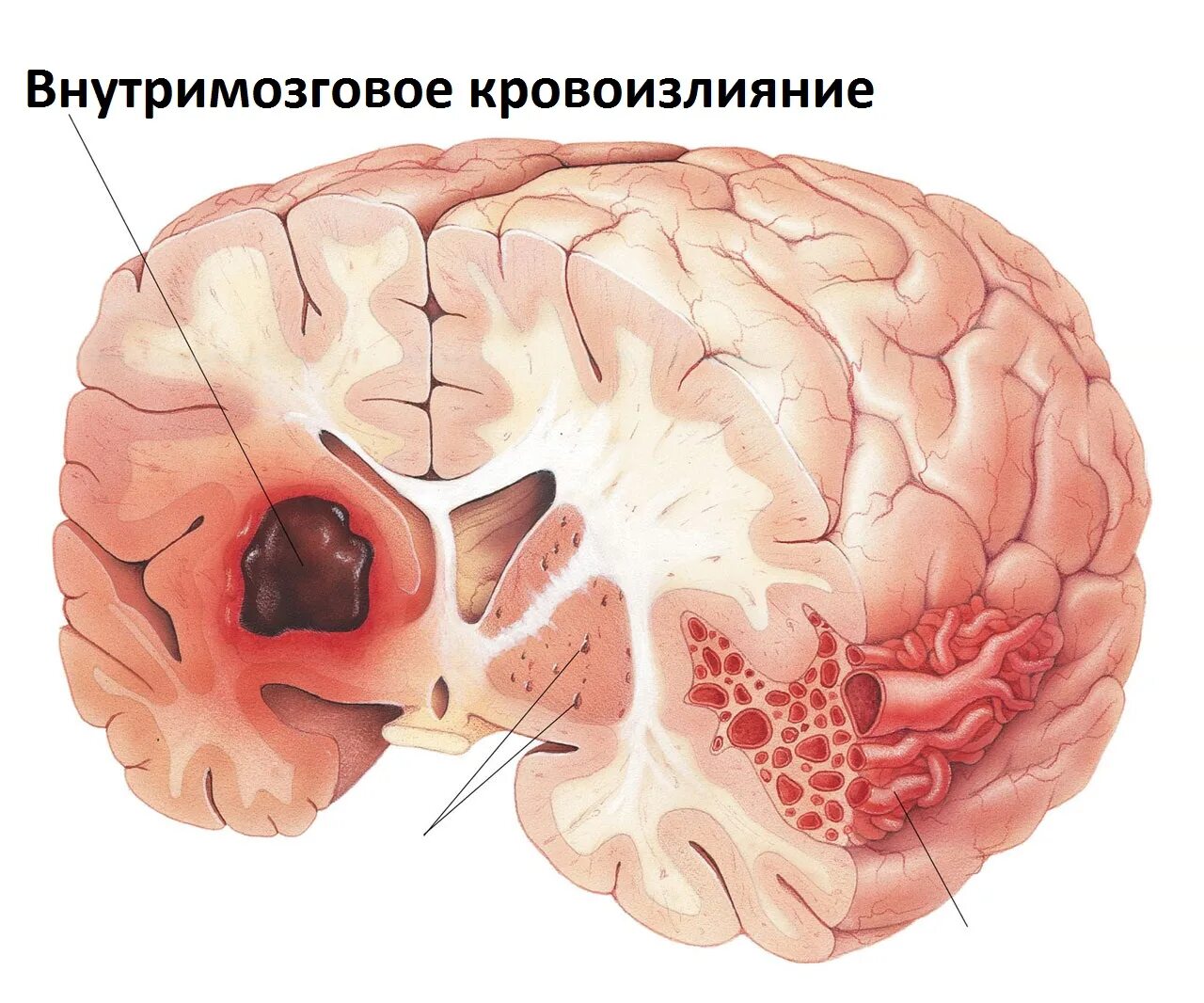 Кт головного мозга при инсульте. Ишемический обширный инсульт мозга. Механизм формирования инфаркта мозга ишемический инсульт. Геморрагический венозный инсульт. Субарахноидальное кровоизлияние в мозг макропрепарат.