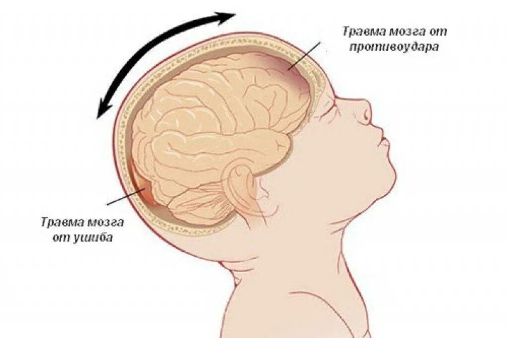 Чмт у детей. Чмт у детей
