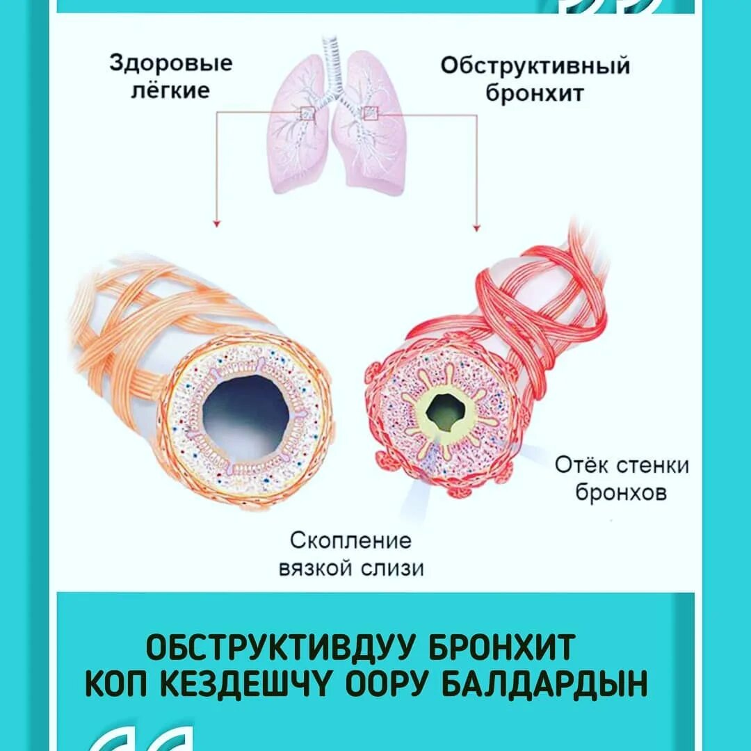 бронхит лечение у взрослых. прием пульмонолога. хронический бронхит синдромы клиники. листок нетрудоспособности при остром бронхите. доктор слушает пациента.