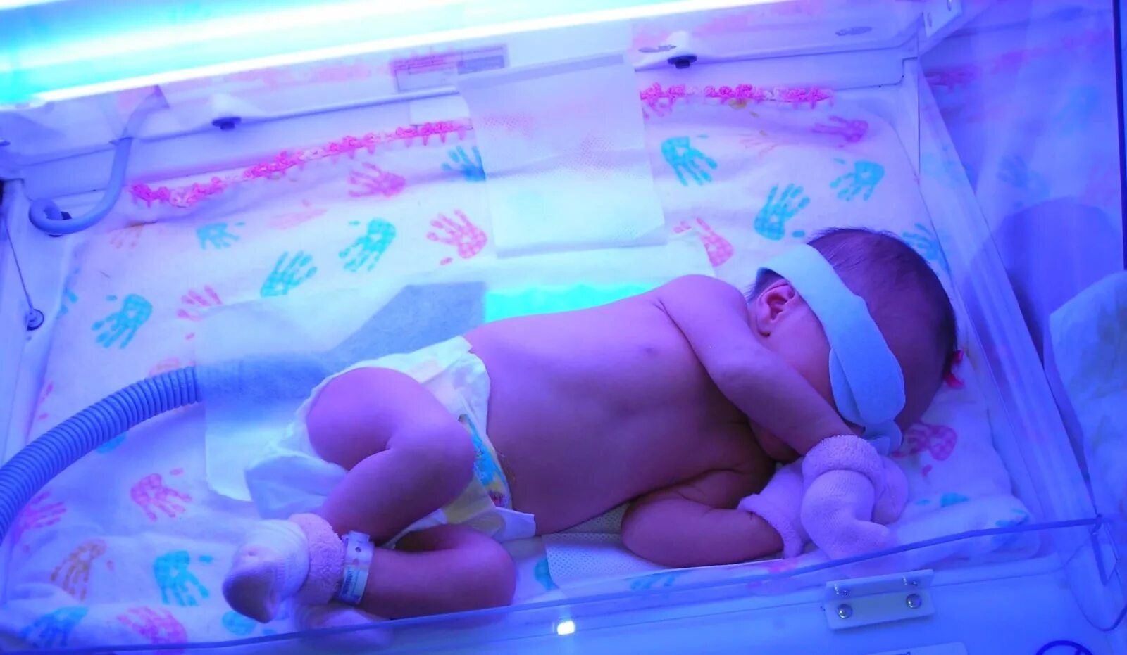 Фототерапия недоношенных новорожденных. Желтушка у новорожденных билирубин. Желтушка билирубин у новорождённого. Фототерапия желтухи у новорожденных.