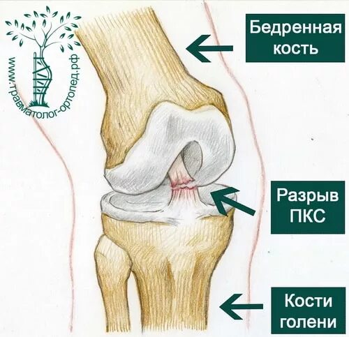 Разрыв связки у собаки. Разрыв связок ПКС коленного сустава. ПКС (передняя крестообразная связка). Крестообразная связка коленного сустава у собак. Повреждения передней крестовидной связки у собаки.