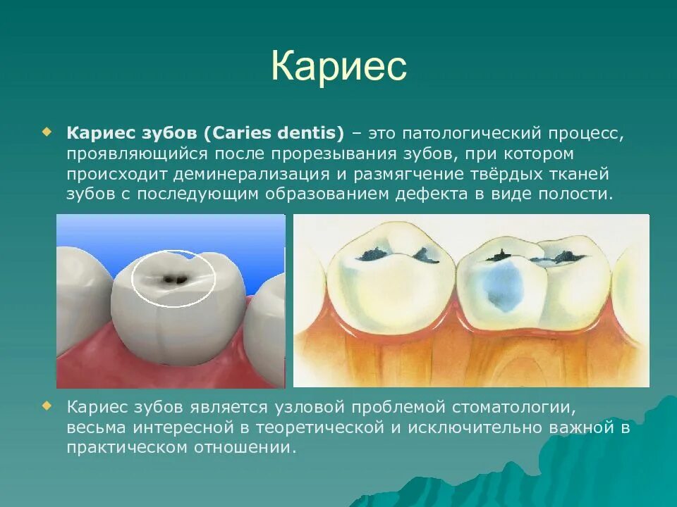 Кариозная полость сообщается с полостью зуба. Профилактика кариеса зубов. стадии образования кариеса. кариес на поверхности зуба.