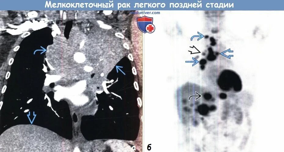 С метастазами 4 степени сколько живут. Онкология легких 4 стадия. Четвёртая стадия онкологии лёгких. Опухоль легких 4 стадии. Онкология 4 стадии с метастазами в легкие.