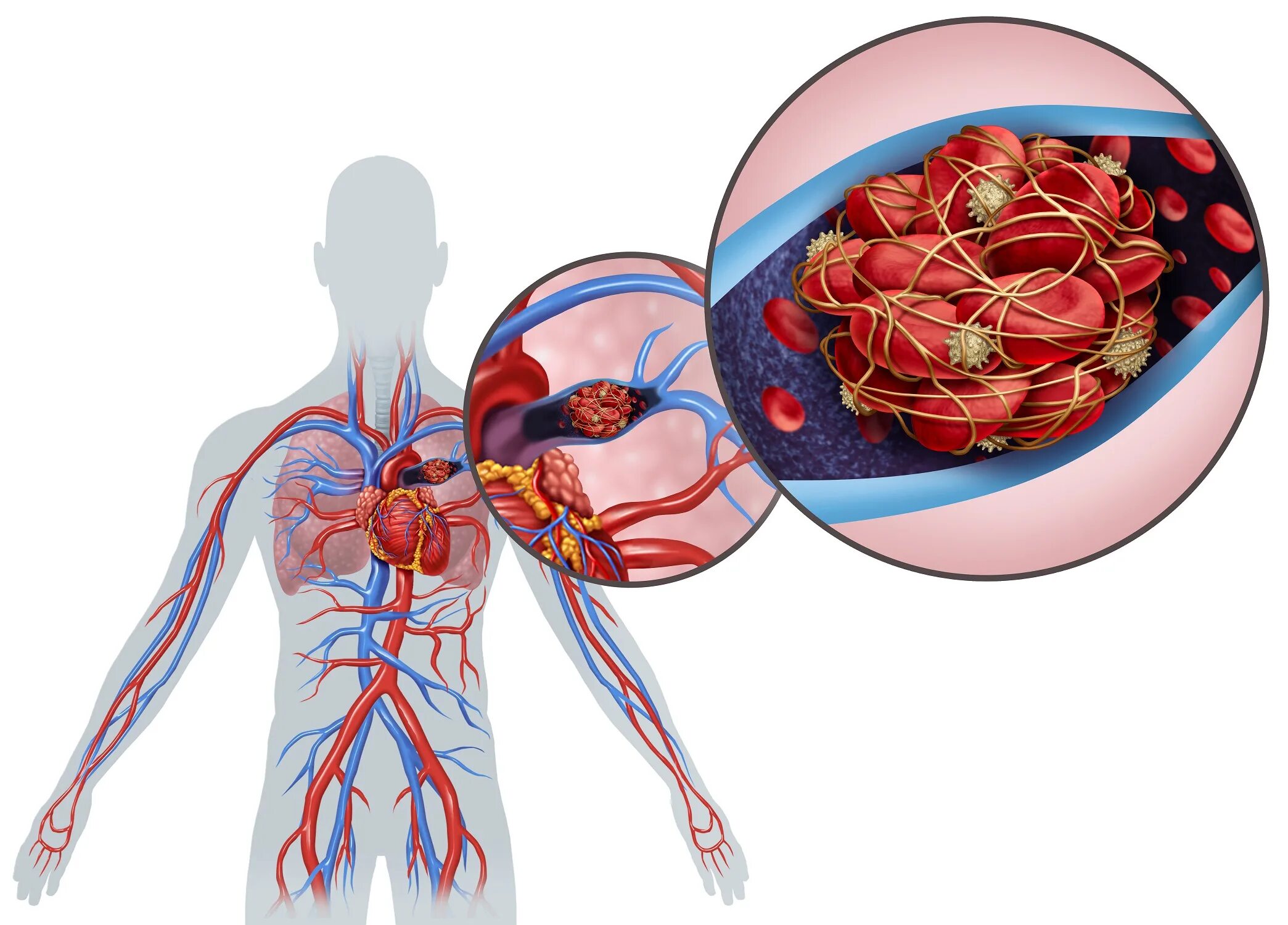 Тромбоэмболия легочной артерии. Тромб легочной артерии тромбоэмболия. Тромбоэмболия легочной артерии (Тэла). Тромбоз кровотечение