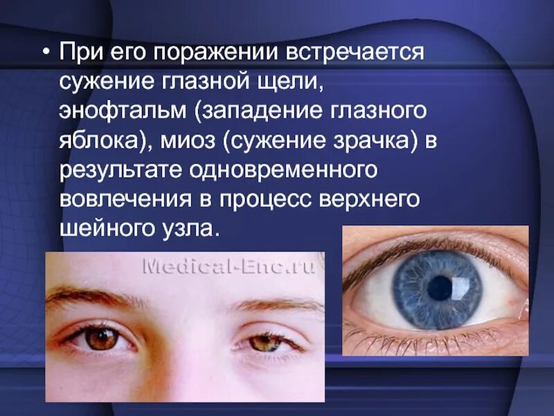 Опущение зрачка