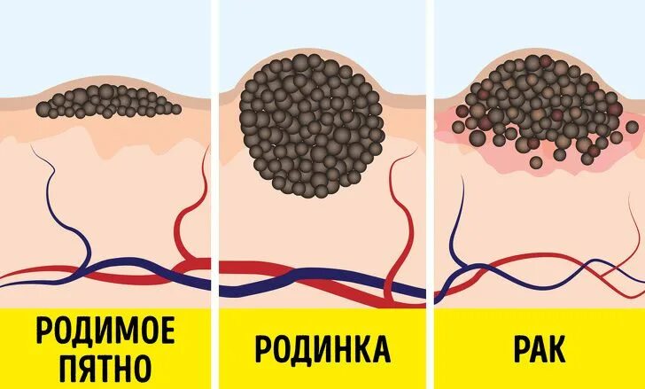 Что находится внутри родинки Обследуй родинки СОХРАНИ СВОЮ ЖИЗНЬ! Сахалинский областной кожно-венерологич