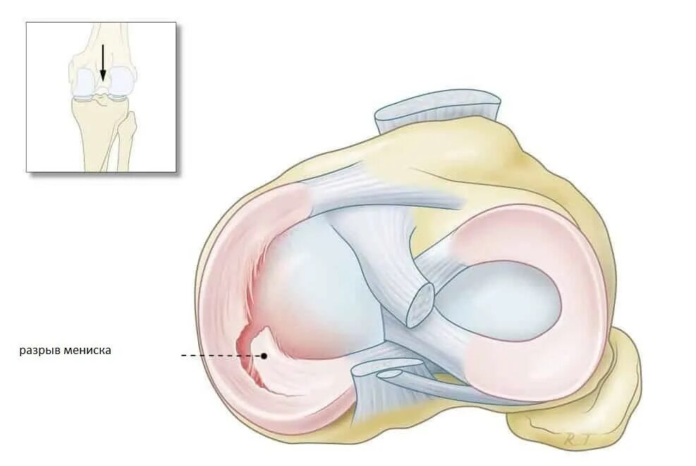 Типы разрывов мениска. Радиальный разрыв мениска. Гемартроз коленного сустава УЗИ. Механизм повреждения менисков. Связки менисков.