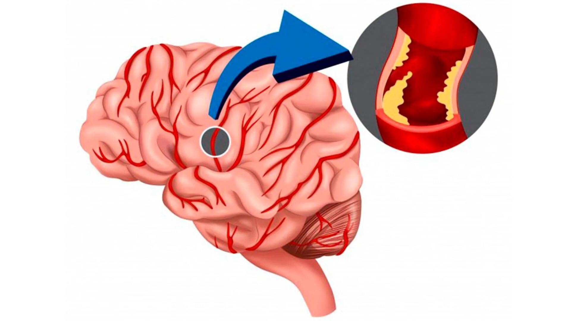 Ишемический инсульт головного мозга клиника. Ишемический инсульт поражения артерий. Ишемическое поражение мозга. Закупорка головных сосудов