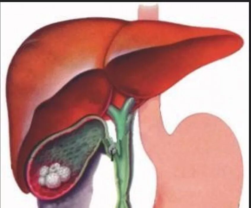 Жкб печени. ЖКБ камни желчного пузыря. Желчнокаменная болезнь (холелитиаз). Желчнокаменная болезнь холецистит. ЖКБ хронический холецистит.