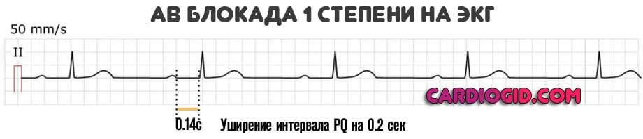 Блокада на первом. АВ блокада 1 степени на ЭКГ. Блокада на ЭКГ АВ блокада 1 степени. Атриовентрикулярные блокады 1 степени ЭКГ. Атриовентрикулярная блокада 1 степени на ЭКГ.