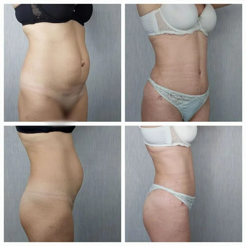 липосакция и липофилинг. липосакция и липофилинг. липосакция и липофилинг. увеличение ягодиц собственным жиром. липосакция и липофилинг.