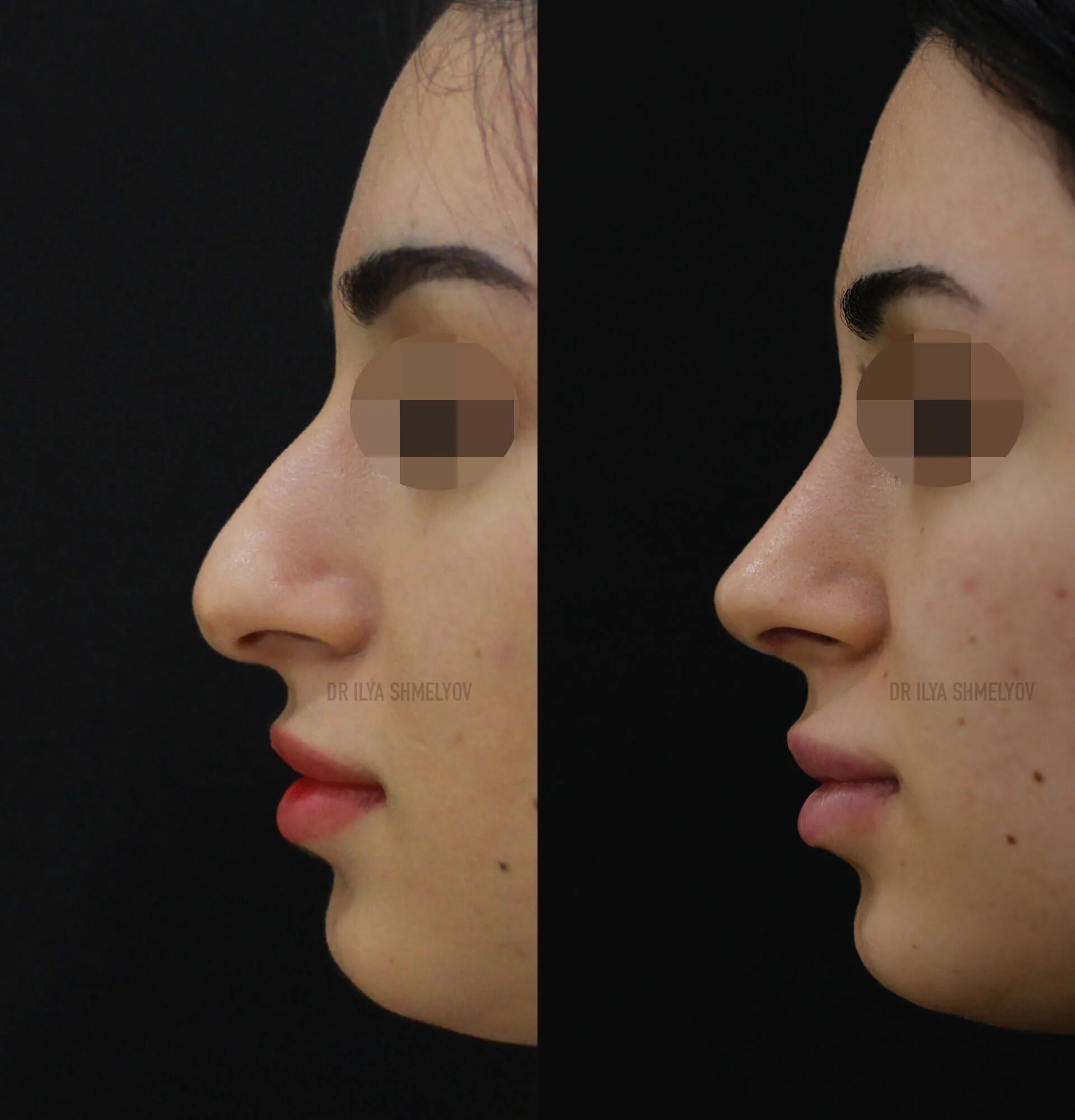 ринопластика спинки носа. ринопластика спинка носа. ринопластика спинка носа. аганесов ринопластика. гюсан сергей арсентьевич.