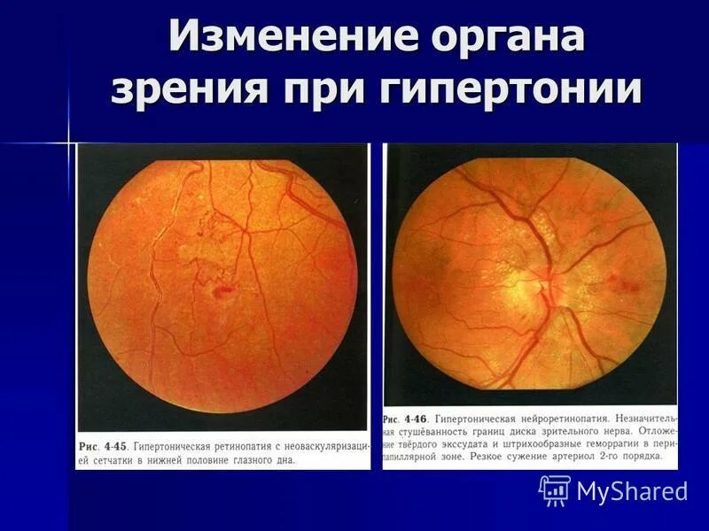Гипертоническая ретинопатия глазное дно. Изменения на глазном дне. Изменения глазного дна при гипертонической болезни.