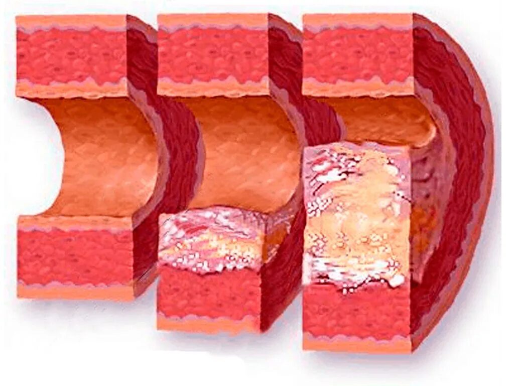 Распад сосудов. Атеросклероз кардиосклероз. Атеросклероз аорты, атеросклеротический кардиосклероз. Атеросклероз и образование атеросклеротических бляшек. Атеросклероз холестериновая бляшка.