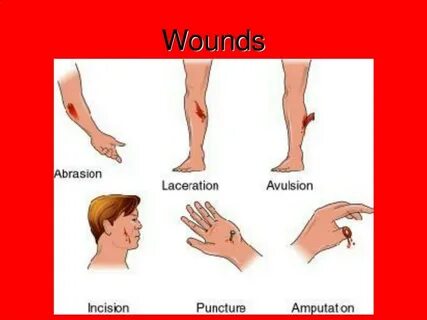 Wound up