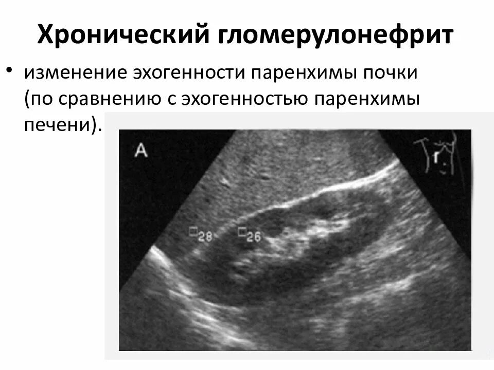 Утолщение паренхимы почек. Хронический гломерулонефрит узи почек. хронический гломерулонефрит узи. острый гломерулонефрит узи признаки. узи признаки острого гломерулонефрита у детей.