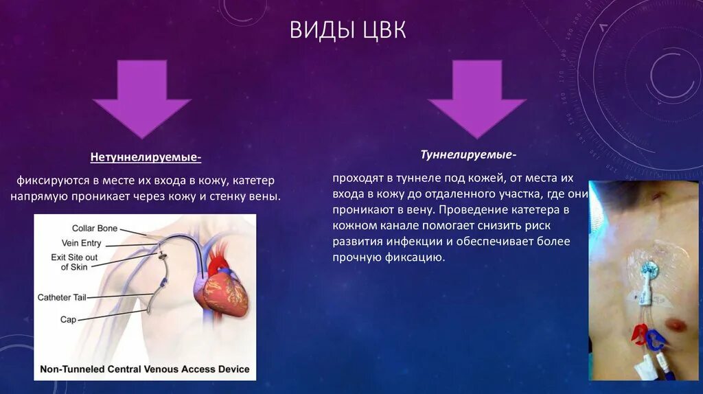 ЦВК Центральный венозный катетер. Туннелируемый Центральный венозный катетер. Виды центральных венозных катетеров. Виды ЦВК. Уход за венозным катетером алгоритм