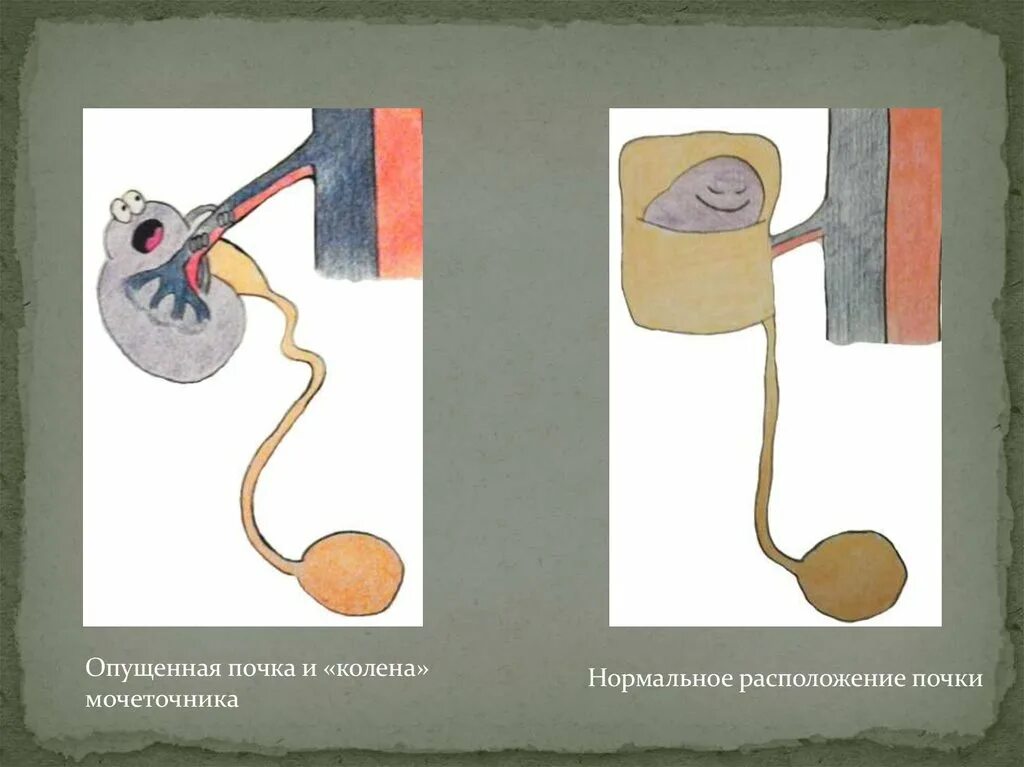 Могут ли опуститься почки. Боли при опущении почки