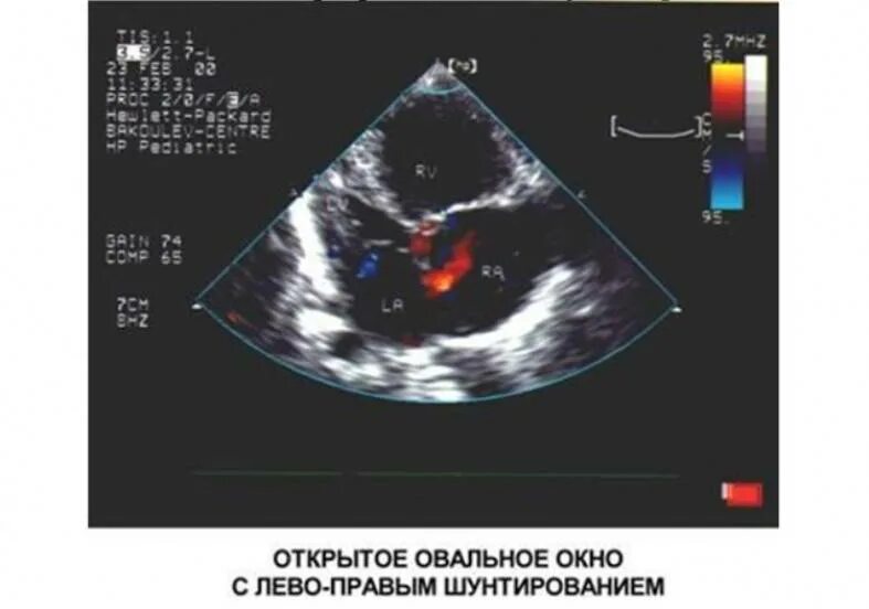 Где находится овальное окно. Открытое овальное окно эхокардиография. УЗИ сердца открытое овальное окно у грудничка. Открытое овальное окошко у новорожденного. Открытое овальное окно в сердце у новорожденного 2мм.