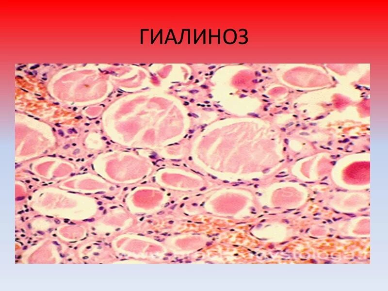 Мезенхимальные белковые. Мезенхимальные дистрофии патанатомия. Гиалиноз паренхиматозная дистрофия. Белковые мезенхимальные дистрофии гиалиноз. Гиалиноз артериол головного мозга.