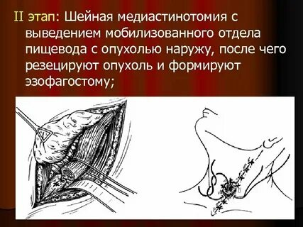 Эзофагостома