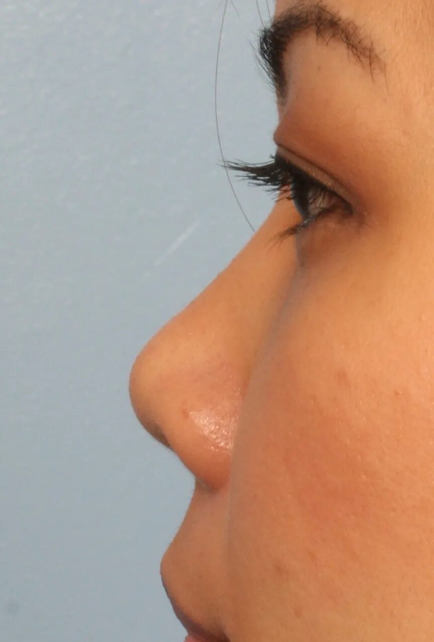 Искривление носовой перегородки. Глубокие ноздри. Глубокие ноздри. Септопластика искривление носовой перегородки. Септопластика искривление носовой перегородки.